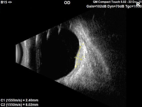 Choroidal Hemangioma Requiring PDT repeatedly
64 year old man.  Diagnosed with hemangioma in 2015.  PDT in 2016.  Images are from 2020 when fluid started to reaccumulate.  Needed PDT repeated two more times.
PDT treatments: [1] 2/19/2015 -Â  Pavan (IOPÂ  problem after PDT)Â  AND [2] 11/2/21 PDT (7 mm temporal to fovea) - SMCÂ  AND [3] 7/22/22 PDT 7.5 mm Temporal to the fovea
