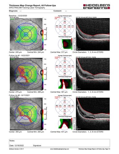 Choroidal Hemangioma Requiring PDT repeatedly
64 year old man.  Diagnosed with hemangioma in 2015.  PDT in 2016.  Images are from 2020 when fluid started to reaccumulate.  Needed PDT repeated two more times.
PDT treatments: [1] 2/19/2015 -Â  Pavan (IOPÂ  problem after PDT)Â  AND [2] 11/2/21 PDT (7 mm temporal to fovea) - SMCÂ  AND [3] 7/22/22 PDT 7.5 mm Temporal to the fovea
