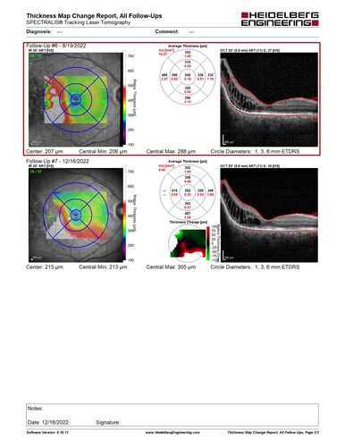 Choroidal Hemangioma Requiring PDT repeatedly
64 year old man.  Diagnosed with hemangioma in 2015.  PDT in 2016.  Images are from 2020 when fluid started to reaccumulate.  Needed PDT repeated two more times.
PDT treatments: [1] 2/19/2015 -Â  Pavan (IOPÂ  problem after PDT)Â  AND [2] 11/2/21 PDT (7 mm temporal to fovea) - SMCÂ  AND [3] 7/22/22 PDT 7.5 mm Temporal to the fovea

