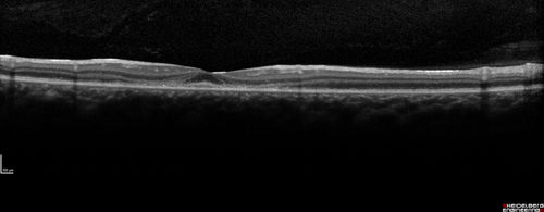 Subretinal Hemorrhage - Commotio Retinae - Macula - hit with baseball
15 year old with VA 20/60 3 days after being hit with baseball in the right eye
