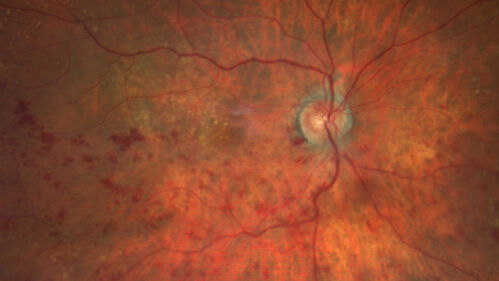 Hemi-CRVO - dual trunk vein
81 year old female mild vision loss - Anatomy shows dual trunk vein with one blocked.  About 20 percent of people have this anatomy
