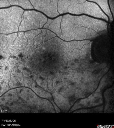 Hemi-CRVO - dual trunk vein
81 year old female mild vision loss - Anatomy shows dual trunk vein with one blocked.  About 20 percent of people have this anatomy
