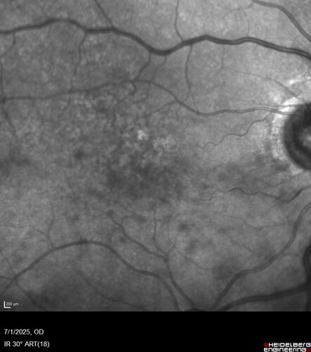 Hemi-CRVO - dual trunk vein
81 year old female mild vision loss - Anatomy shows dual trunk vein with one blocked.  About 20 percent of people have this anatomy
