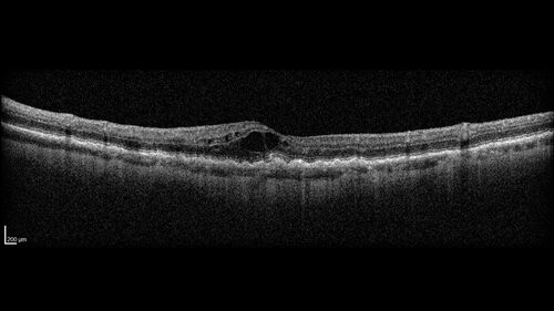 Hemi-CRVO - dual trunk vein
81 year old female mild vision loss - Anatomy shows dual trunk vein with one blocked.  About 20 percent of people have this anatomy
