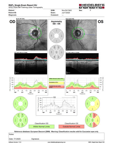 Hemi-CRVO - dual trunk vein
81 year old female mild vision loss - Anatomy shows dual trunk vein with one blocked.  About 20 percent of people have this anatomy
