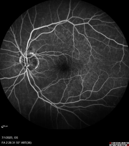 Hemi-CRVO - dual trunk vein
81 year old female mild vision loss - Anatomy shows dual trunk vein with one blocked.  About 20 percent of people have this anatomy
