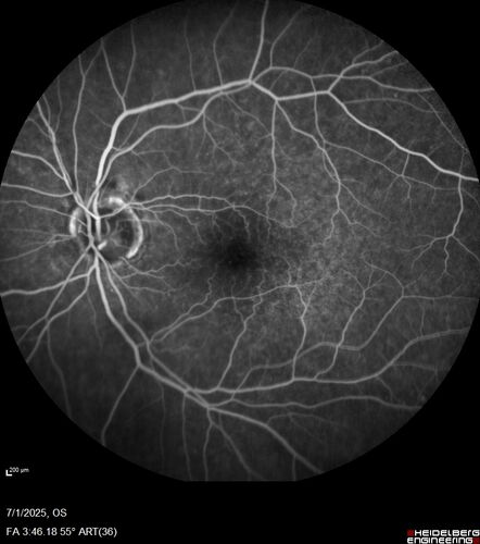 Hemi-CRVO - dual trunk vein
81 year old female mild vision loss - Anatomy shows dual trunk vein with one blocked.  About 20 percent of people have this anatomy
