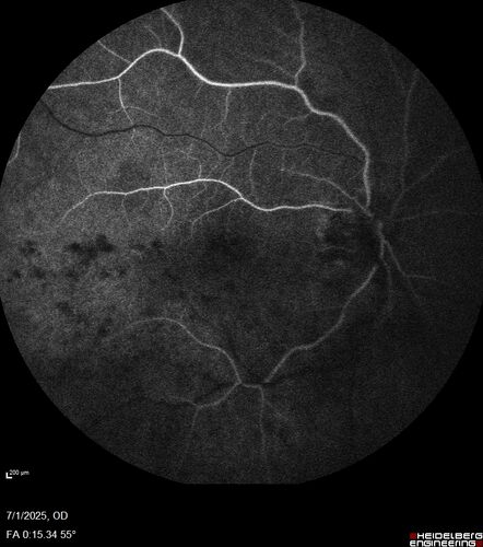 Hemi-CRVO - dual trunk vein
81 year old female mild vision loss - Anatomy shows dual trunk vein with one blocked.  About 20 percent of people have this anatomy
