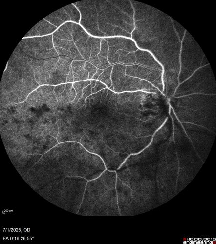 Hemi-CRVO - dual trunk vein
81 year old female mild vision loss - Anatomy shows dual trunk vein with one blocked.  About 20 percent of people have this anatomy
