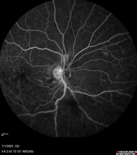 Hemi-CRVO - dual trunk vein
81 year old female mild vision loss - Anatomy shows dual trunk vein with one blocked.  About 20 percent of people have this anatomy
