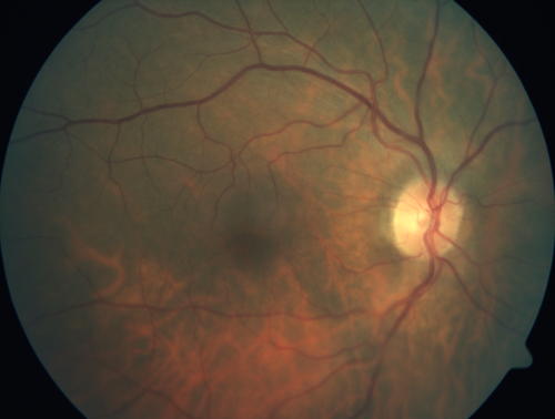 Hemicentral Vein Occlusion Left Eye
Vision improved from 20/100 - 2 to 20/32 with 5 monthly Avastin treatments.
