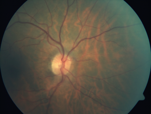 Hemicentral Vein Occlusion Left Eye
Vision improved from 20/100 - 2 to 20/32 with 5 monthly Avastin treatments.
