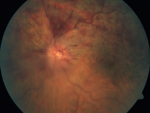 Hemicentral Vein Occlusion Left Eye
Vision improved from 20/100 - 2 to 20/32 with 5 monthly Avastin treatments.
