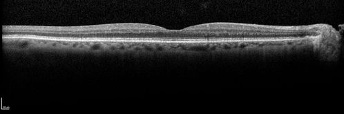 Hemicentral Vein Occlusion Left Eye
Vision improved from 20/100 - 2 to 20/32 with 5 monthly Avastin treatments.
