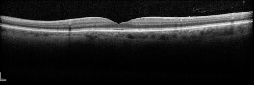 Hemicentral Vein Occlusion Left Eye
Vision improved from 20/100 - 2 to 20/32 with 5 monthly Avastin treatments.
