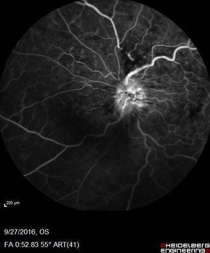 Hemicentral Vein Occlusion Left Eye
Vision improved from 20/100 - 2 to 20/32 with 5 monthly Avastin treatments.
