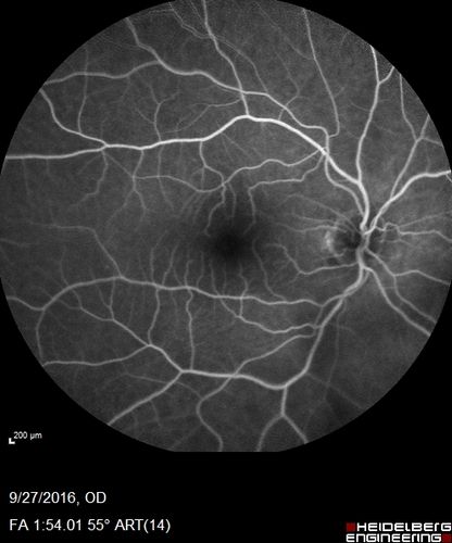 Hemicentral Vein Occlusion Left Eye
Vision improved from 20/100 - 2 to 20/32 with 5 monthly Avastin treatments.
