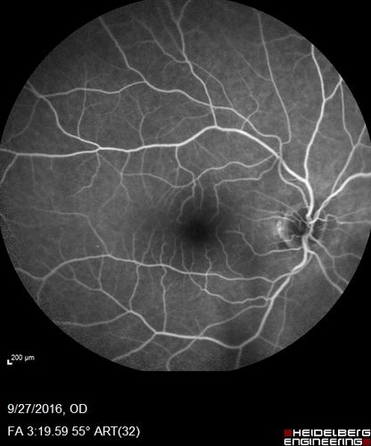 Hemicentral Vein Occlusion Left Eye
Vision improved from 20/100 - 2 to 20/32 with 5 monthly Avastin treatments.
