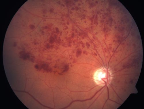 Hemicentral Retinal Vein Occlusion Vision 20/60 
84-year-old man has a hemicentral retinal vein occlusion in the right eye.  His vision has declined since then. 

VISUAL ACUITY:  Vision OD is 20/60.
