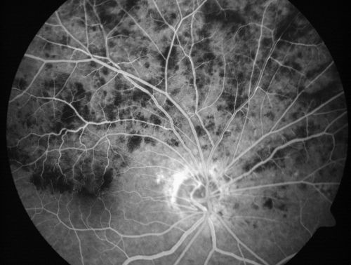 Hemicentral Retinal Vein Occlusion Vision 20/60 
84-year-old man has a hemicentral retinal vein occlusion in the right eye.  His vision has declined since then. 

VISUAL ACUITY:  Vision OD is 20/60.
