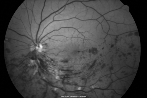 Hemi Central Retinal Vein Occlusion 35 year old non-compliant man
35-year-old man hazy vision in his left eye for about the last three days. OD 20/20,  OS 20/30
