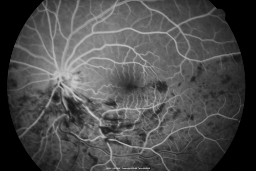 Hemi Central Retinal Vein Occlusion 35 year old non-compliant man
35-year-old man hazy vision in his left eye for about the last three days. OD 20/20,  OS 20/30
