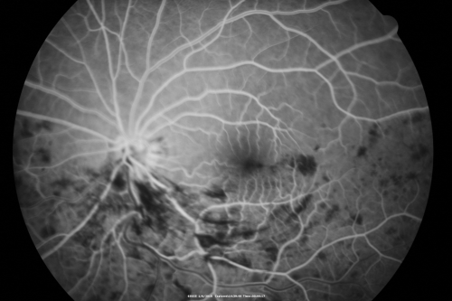 Hemi Central Retinal Vein Occlusion 35 year old non-compliant man
35-year-old man hazy vision in his left eye for about the last three days. OD 20/20,  OS 20/30
