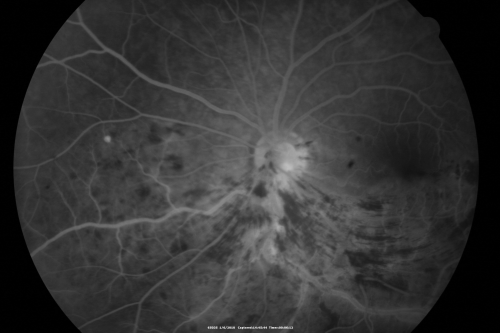 Hemi Central Retinal Vein Occlusion 35 year old non-compliant man
35-year-old man hazy vision in his left eye for about the last three days. OD 20/20,  OS 20/30

