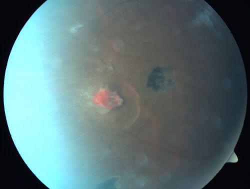 Proliferative Sickle Retinopathy - Hemoglobin SC
53-year-old woman with a new spider-like floater in the right eye for about six days.  She sees one big floater and another little one. She does have hemoglobin SC hemoglobinopathy.  VISUAL ACUITY:  Vision OD is 20/20; OS is 20/50, PH is 20/20. 

