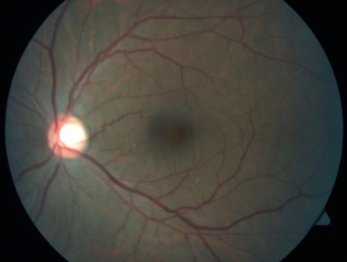 Proliferative Sickle Retinopathy - Hemoglobin SC
53-year-old woman with a new spider-like floater in the right eye for about six days.  She sees one big floater and another little one. She does have hemoglobin SC hemoglobinopathy.  VISUAL ACUITY:  Vision OD is 20/20; OS is 20/50, PH is 20/20. 
