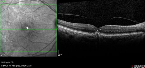Holenhorst Plaque - Small and asymptomatic
72 year old woman with mild dry ARMD.  VA 20/40 OU.  Asymptomatic plaque noted in the right eye.
