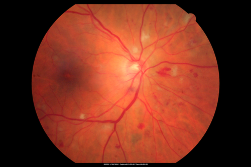Hypertensive Retinopathy - BP 240 / 130 mmHg - Grade 4
71 year old woman who claims to be asymptomatic with decreased vision, macular edema, cotton wool spots, subretinal fluid and optic nerve edema
