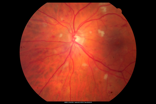 Hypertensive Retinopathy - BP 240 / 130 mmHg - Grade 4
71 year old woman who claims to be asymptomatic with decreased vision, macular edema, cotton wool spots, subretinal fluid and optic nerve edema
