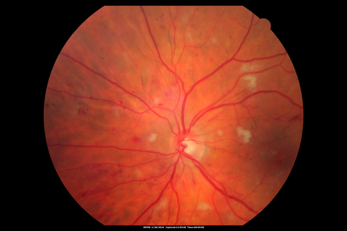 Hypertensive Retinopathy - BP 240 / 130 mmHg - Grade 4
71 year old woman who claims to be asymptomatic with decreased vision, macular edema, cotton wool spots, subretinal fluid and optic nerve edema
