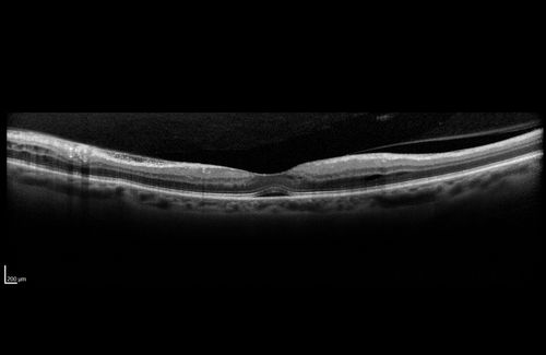 Hypertensive Retinopathy - BP 240 / 130 mmHg - Grade 4
71 year old woman who claims to be asymptomatic with decreased vision, macular edema, cotton wool spots, subretinal fluid and optic nerve edema
