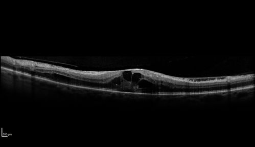 Hypertensive Retinopathy - BP 240 / 130 mmHg - Grade 4
71 year old woman who claims to be asymptomatic with decreased vision, macular edema, cotton wool spots, subretinal fluid and optic nerve edema
