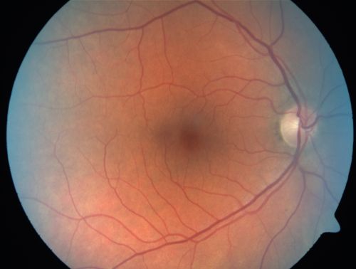Serous Macular Detachment Left Eye - Possible Hypertensive Choroidopathy v. Central Serous Retinopathy
59-year-old woman decreasing vision in the left eye for about two days.  She sees a spot in front of her vision.  It is a yellow spot which is just straight ahead and moves with her eye.  She does have high blood pressure.  She checks her blood pressure at home, and even at home her blood pressure runs very high, with the systolic running around 200 and the diastolic around 100, although occasionally it does return to the normal range.

VISUAL ACUITY: Vision OD is 20/60, OS is 20/30
