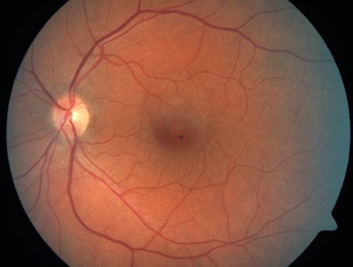 Serous Macular Detachment Left Eye - Possible Hypertensive Choroidopathy v. Central Serous Retinopathy
59-year-old woman decreasing vision in the left eye for about two days.  She sees a spot in front of her vision.  It is a yellow spot which is just straight ahead and moves with her eye.  She does have high blood pressure.  She checks her blood pressure at home, and even at home her blood pressure runs very high, with the systolic running around 200 and the diastolic around 100, although occasionally it does return to the normal range.

VISUAL ACUITY: Vision OD is 20/60, OS is 20/30
