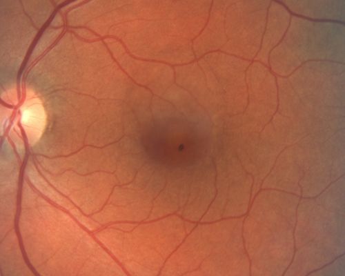 Serous Macular Detachment Left Eye - Possible Hypertensive Choroidopathy v. Central Serous Retinopathy
59-year-old woman decreasing vision in the left eye for about two days.  She sees a spot in front of her vision.  It is a yellow spot which is just straight ahead and moves with her eye.  She does have high blood pressure.  She checks her blood pressure at home, and even at home her blood pressure runs very high, with the systolic running around 200 and the diastolic around 100, although occasionally it does return to the normal range.

VISUAL ACUITY: Vision OD is 20/60, OS is 20/30
