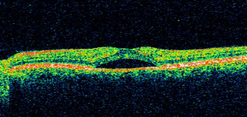 Serous Macular Detachment Left Eye - Possible Hypertensive Choroidopathy v. Central Serous Retinopathy
59-year-old woman decreasing vision in the left eye for about two days.  She sees a spot in front of her vision.  It is a yellow spot which is just straight ahead and moves with her eye.  She does have high blood pressure.  She checks her blood pressure at home, and even at home her blood pressure runs very high, with the systolic running around 200 and the diastolic around 100, although occasionally it does return to the normal range.

VISUAL ACUITY: Vision OD is 20/60, OS is 20/30
