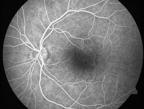 Serous Macular Detachment Left Eye - Possible Hypertensive Choroidopathy v. Central Serous Retinopathy
59-year-old woman decreasing vision in the left eye for about two days.  She sees a spot in front of her vision.  It is a yellow spot which is just straight ahead and moves with her eye.  She does have high blood pressure.  She checks her blood pressure at home, and even at home her blood pressure runs very high, with the systolic running around 200 and the diastolic around 100, although occasionally it does return to the normal range.

VISUAL ACUITY: Vision OD is 20/60, OS is 20/30
