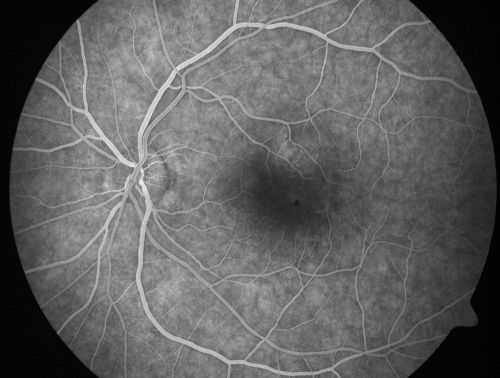 Serous Macular Detachment Left Eye - Possible Hypertensive Choroidopathy v. Central Serous Retinopathy
59-year-old woman decreasing vision in the left eye for about two days.  She sees a spot in front of her vision.  It is a yellow spot which is just straight ahead and moves with her eye.  She does have high blood pressure.  She checks her blood pressure at home, and even at home her blood pressure runs very high, with the systolic running around 200 and the diastolic around 100, although occasionally it does return to the normal range.

VISUAL ACUITY: Vision OD is 20/60, OS is 20/30
