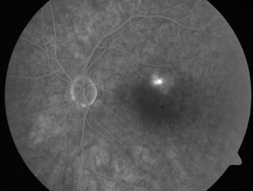 Serous Macular Detachment Left Eye - Possible Hypertensive Choroidopathy v. Central Serous Retinopathy
59-year-old woman decreasing vision in the left eye for about two days.  She sees a spot in front of her vision.  It is a yellow spot which is just straight ahead and moves with her eye.  She does have high blood pressure.  She checks her blood pressure at home, and even at home her blood pressure runs very high, with the systolic running around 200 and the diastolic around 100, although occasionally it does return to the normal range.

VISUAL ACUITY: Vision OD is 20/60, OS is 20/30
