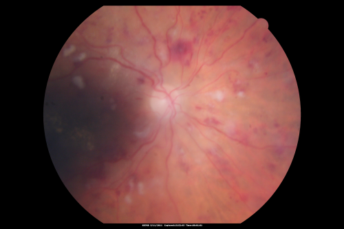 Malignany Hypertension - BP 250/130 - Vision 1/200 in each eye - Diabetic
68-year-old woman poor vision in both eyes for the last few years.  She is diabetic since 1989.  Her blood pressure has been very high.  She was in the hospital Friday.  Her blood pressure during that visit was 250/130 and her blood pressure in your office she reports was somewhere around the same.  I just checked her blood pressure at the beginning of my visit and it was 200/120 in her right arm sitting.  Her vision is poor enough that she can barely see to walk around.  She has also been feeling nauseous 
