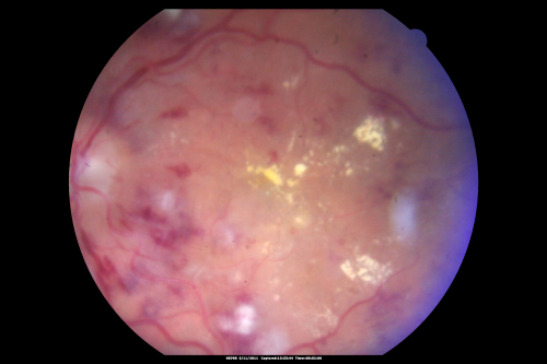 Malignany Hypertension - BP 250/130 - Vision 1/200 in each eye - Diabetic
68-year-old woman poor vision in both eyes for the last few years.  She is diabetic since 1989.  Her blood pressure has been very high.  She was in the hospital Friday.  Her blood pressure during that visit was 250/130 and her blood pressure in your office she reports was somewhere around the same.  I just checked her blood pressure at the beginning of my visit and it was 200/120 in her right arm sitting.  Her vision is poor enough that she can barely see to walk around.  She has also been feeling nauseous 
