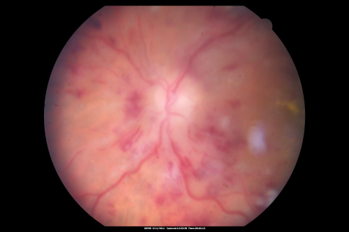 Malignany Hypertension - BP 250/130 - Vision 1/200 in each eye - Diabetic
68-year-old woman poor vision in both eyes for the last few years.  She is diabetic since 1989.  Her blood pressure has been very high.  She was in the hospital Friday.  Her blood pressure during that visit was 250/130 and her blood pressure in your office she reports was somewhere around the same.  I just checked her blood pressure at the beginning of my visit and it was 200/120 in her right arm sitting.  Her vision is poor enough that she can barely see to walk around.  She has also been feeling nauseous 
