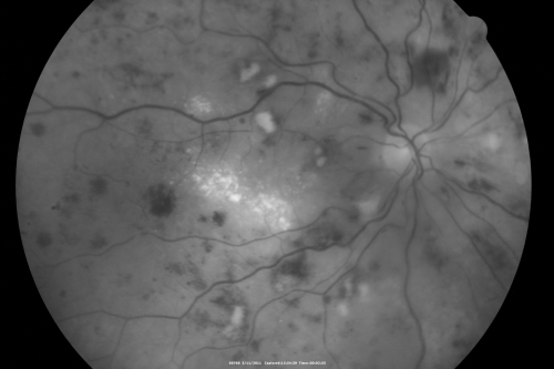 Malignany Hypertension - BP 250/130 - Vision 1/200 in each eye - Diabetic
68-year-old woman poor vision in both eyes for the last few years.  She is diabetic since 1989.  Her blood pressure has been very high.  She was in the hospital Friday.  Her blood pressure during that visit was 250/130 and her blood pressure in your office she reports was somewhere around the same.  I just checked her blood pressure at the beginning of my visit and it was 200/120 in her right arm sitting.  Her vision is poor enough that she can barely see to walk around.  She has also been feeling nauseous 
