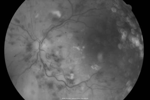 Malignany Hypertension - BP 250/130 - Vision 1/200 in each eye - Diabetic
68-year-old woman poor vision in both eyes for the last few years.  She is diabetic since 1989.  Her blood pressure has been very high.  She was in the hospital Friday.  Her blood pressure during that visit was 250/130 and her blood pressure in your office she reports was somewhere around the same.  I just checked her blood pressure at the beginning of my visit and it was 200/120 in her right arm sitting.  Her vision is poor enough that she can barely see to walk around.  She has also been feeling nauseous 
