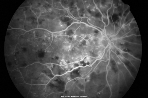 Malignany Hypertension - BP 250/130 - Vision 1/200 in each eye - Diabetic
68-year-old woman poor vision in both eyes for the last few years.  She is diabetic since 1989.  Her blood pressure has been very high.  She was in the hospital Friday.  Her blood pressure during that visit was 250/130 and her blood pressure in your office she reports was somewhere around the same.  I just checked her blood pressure at the beginning of my visit and it was 200/120 in her right arm sitting.  Her vision is poor enough that she can barely see to walk around.  She has also been feeling nauseous 
