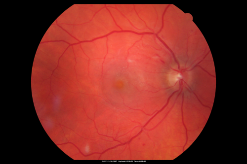 Hypertensive Retinopathy One Year later with good Vision   IgA Nephropathy
OD 20/30, OS 20/25 One year following initial episode.
